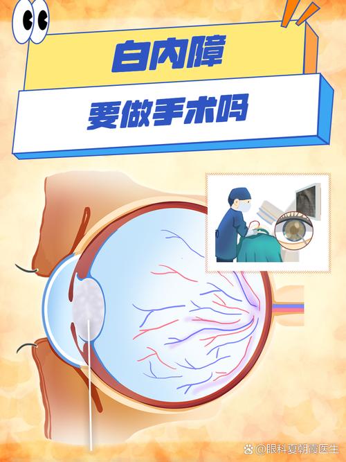 白内障是否需要手术只需要看视力水平吗？