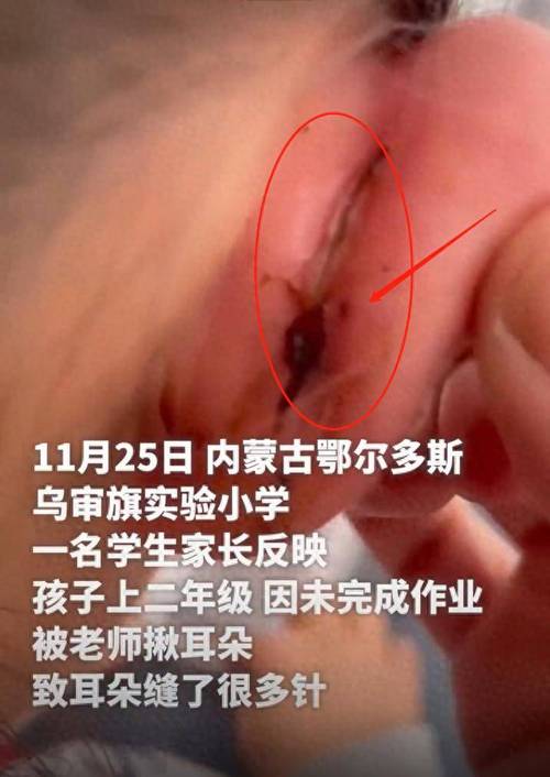 一年级女生课堂上“走神”被老师揪伤耳朵缝5针；教育局：涉事者已被停课
